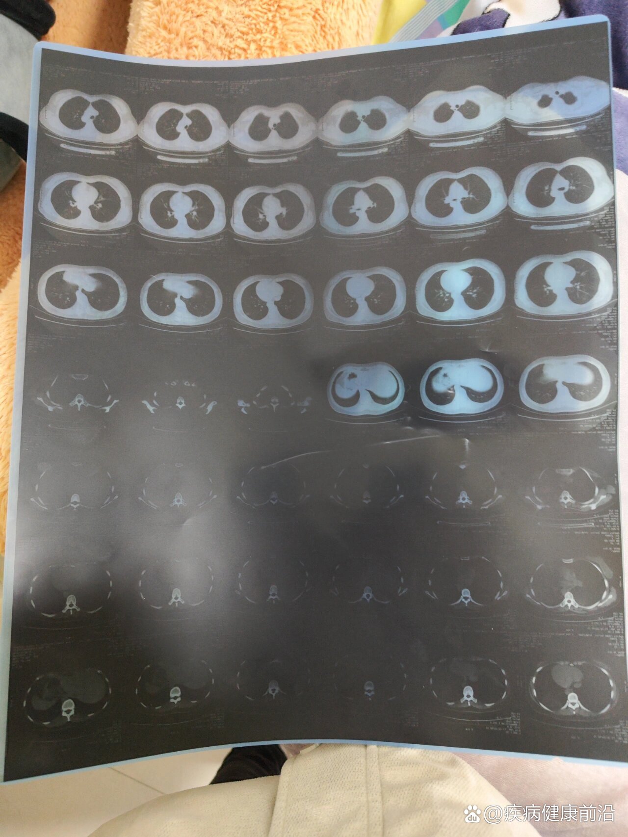 “新型肺炎确诊病例	” 新型病毒确诊病例？-第2张图片